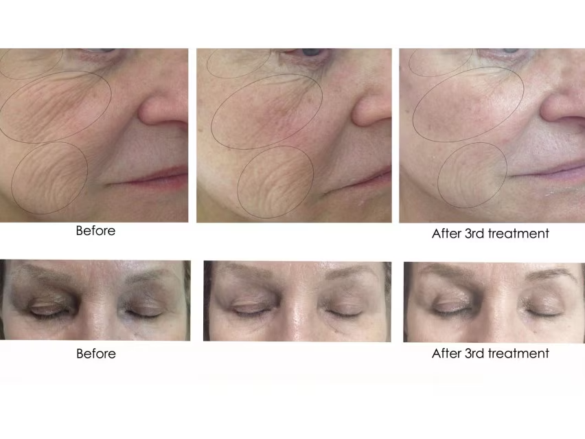 CO2 Lift Pro Carboxy Gel Mask